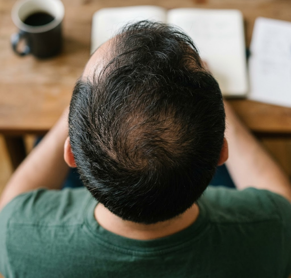 1-male pattern baldness.png